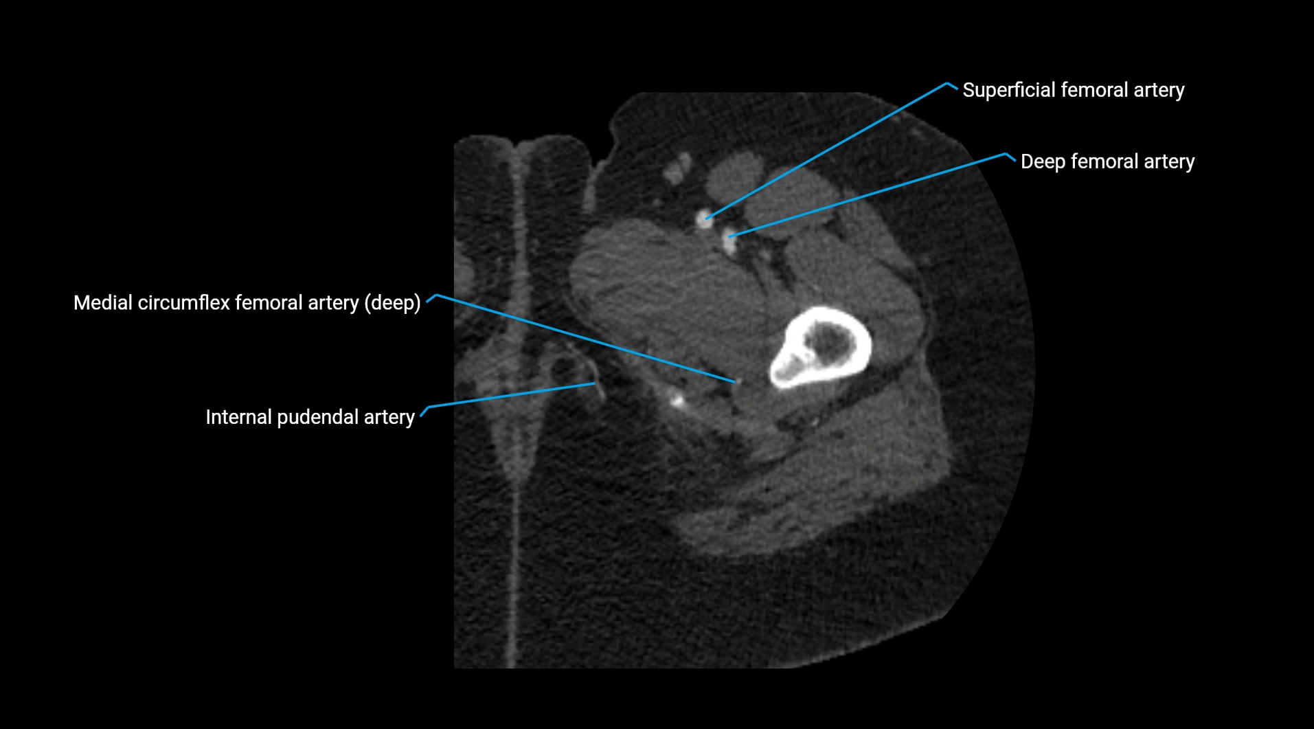 CTA lower limb cross sectional anatomy labelled image _77.webp